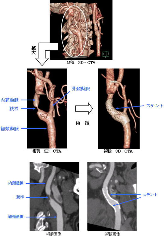 頚動脈に対するステント留置術（CAS） | 藍の都脳神経外科病院